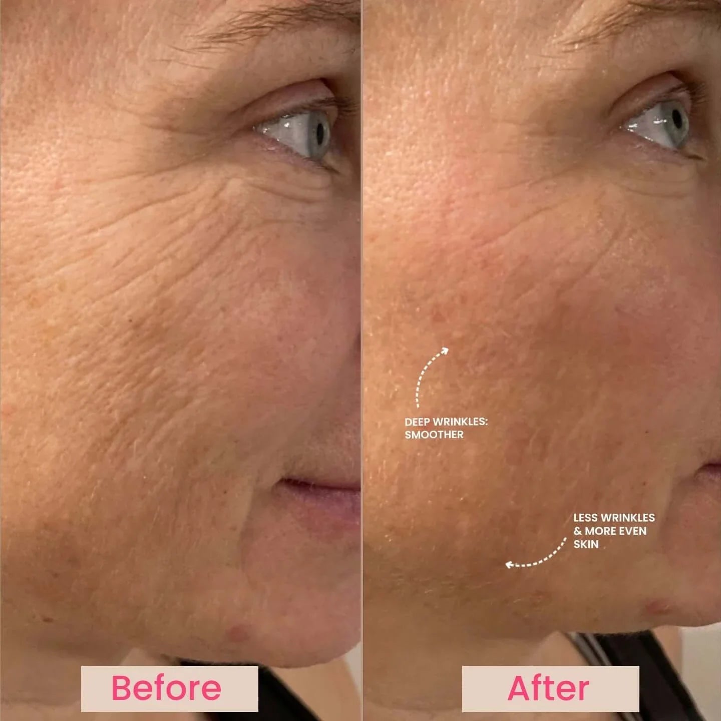 INDA LUMO Anti-Aging Handset